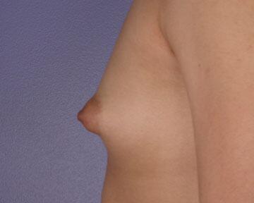 Breast Augmentation Before & After Image