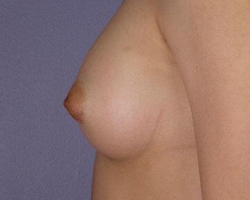 Breast Augmentation Before & After Image