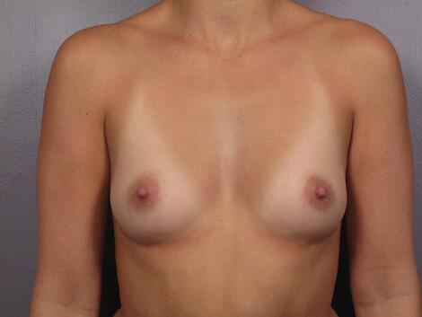 Breast Augmentation Before & After Image