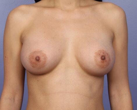 Breast Augmentation Before & After Image