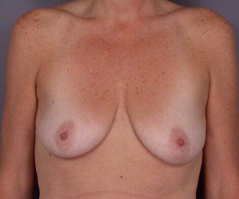 Breast Augmentation Before & After Image