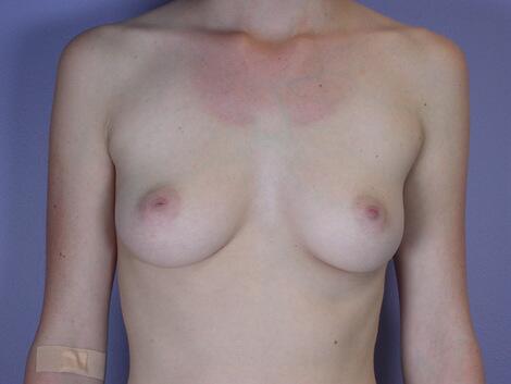 Breast Augmentation Before & After Image