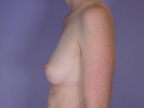 Breast Augmentation Before & After Image