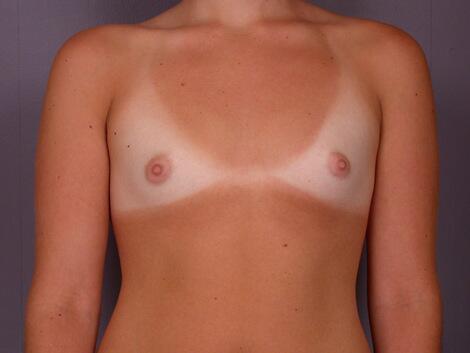 Breast Augmentation Before & After Image