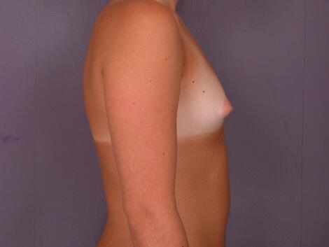 Breast Augmentation Before & After Image