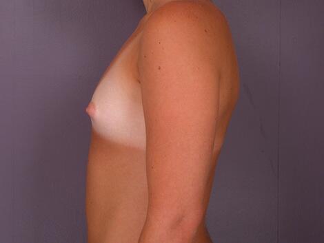 Breast Augmentation Before & After Image