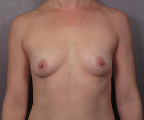 Breast Augmentation Before & After Image