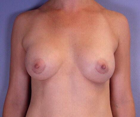 Breast Augmentation Before & After Image