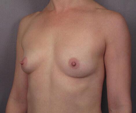 Breast Augmentation Before & After Image