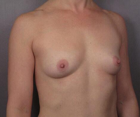 Breast Augmentation Before & After Image