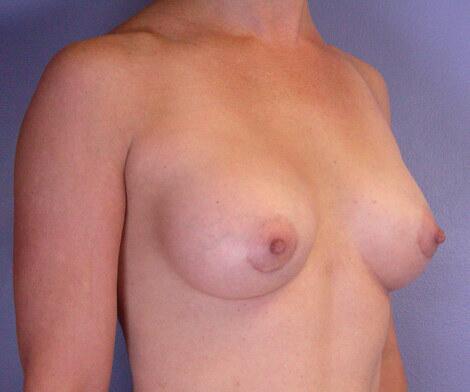 Breast Augmentation Before & After Image