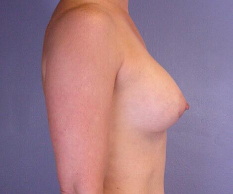 Breast Augmentation Before & After Image