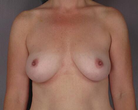 Breast Augmentation Before & After Image