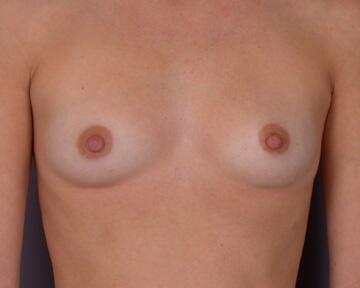 Breast Augmentation Before & After Image