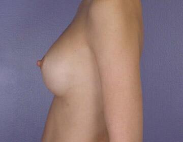 Breast Augmentation Before & After Image