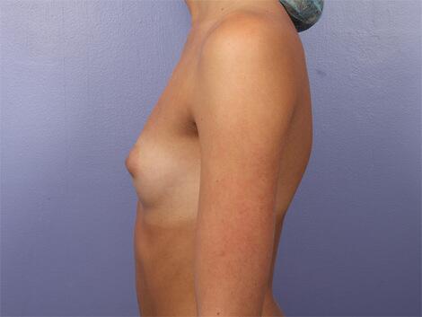 Breast Augmentation Before & After Image