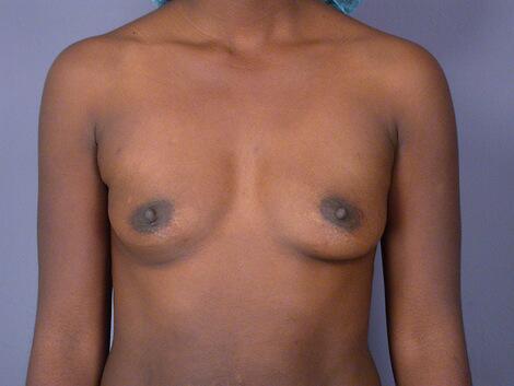 Breast Augmentation Before & After Image