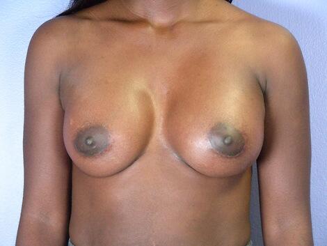 Breast Augmentation Before & After Image