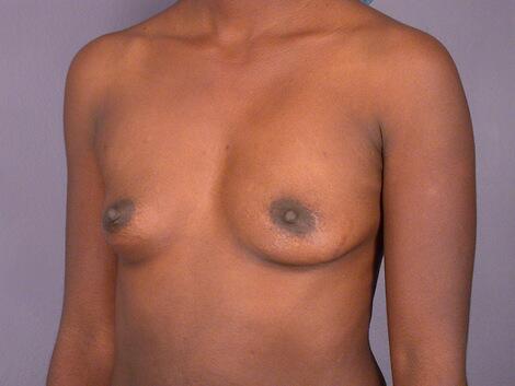 Breast Augmentation Before & After Image