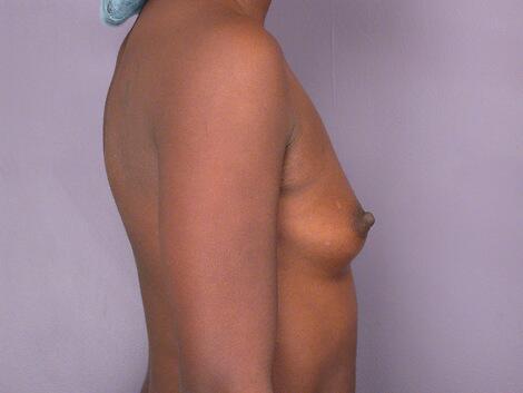 Breast Augmentation Before & After Image