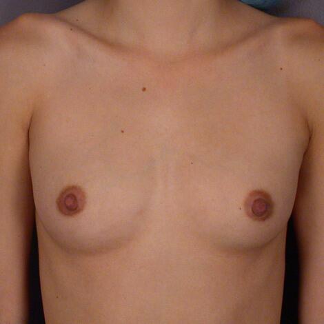 Breast Augmentation Before & After Image