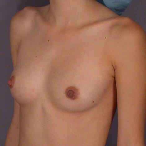 Breast Augmentation Before & After Image