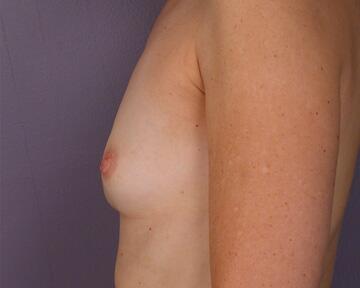 Breast Augmentation Before & After Image