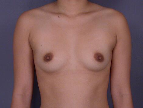 Breast Augmentation Before & After Image