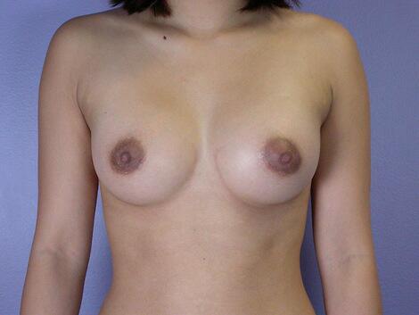 Breast Augmentation Before & After Image