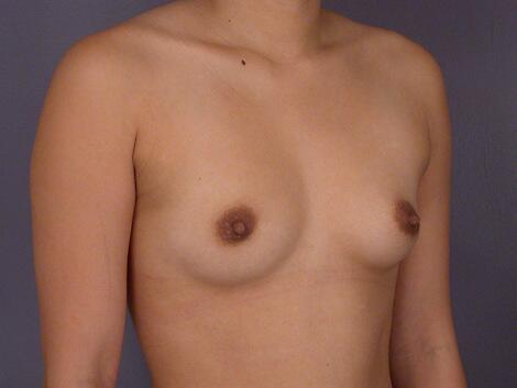 Breast Augmentation Before & After Image