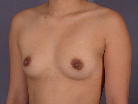 Breast Augmentation Before & After Image