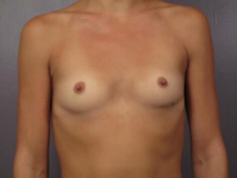 Breast Augmentation Before & After Image