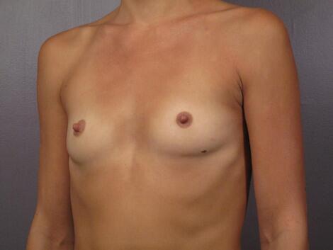 Breast Augmentation Before & After Image