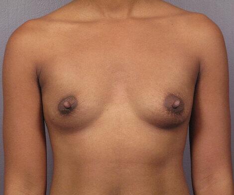 Breast Augmentation Before & After Image