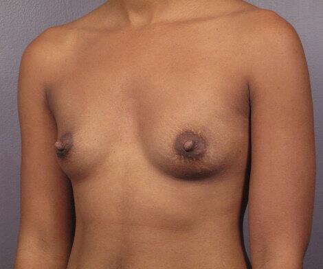 Breast Augmentation Before & After Image