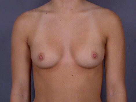 Breast Augmentation Before & After Image