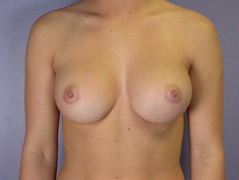 Breast Augmentation Before & After Image