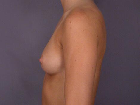 Breast Augmentation Before & After Image