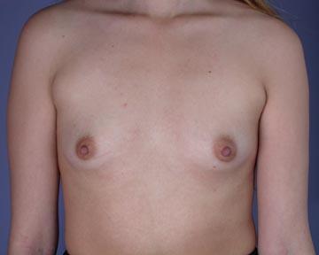 Breast Augmentation Before & After Image