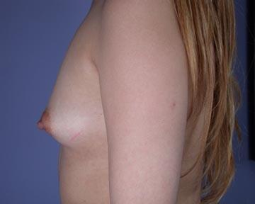 Breast Augmentation Before & After Image