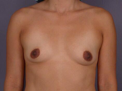 Breast Augmentation Before & After Image