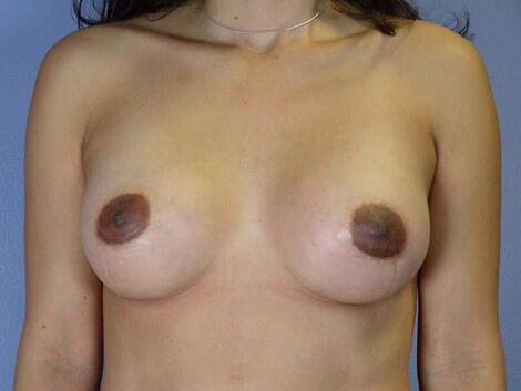 Breast Augmentation Before & After Image