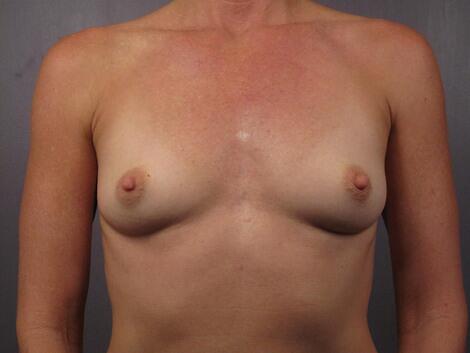 Breast Augmentation Before & After Image