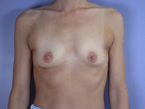 Breast Augmentation Before & After Image