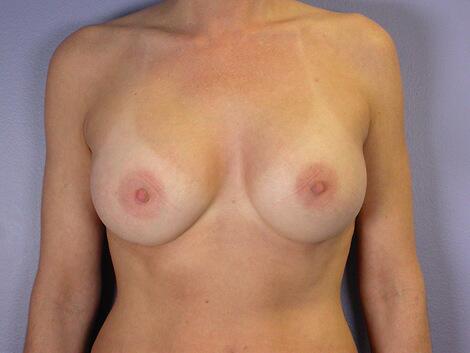 Breast Augmentation Before & After Image