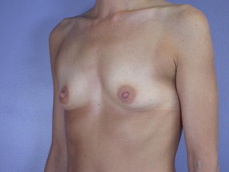 Breast Augmentation Before & After Image