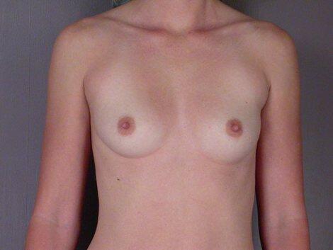 Breast Augmentation Before & After Image