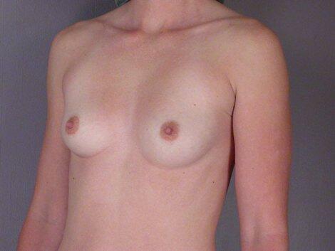 Breast Augmentation Before & After Image