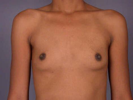 Breast Augmentation Before & After Image