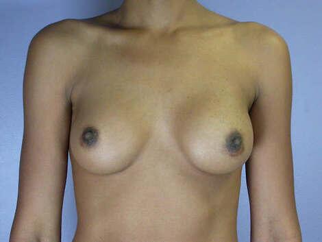 Breast Augmentation Before & After Image